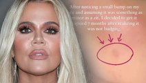 Khloe Kardashian Reveals Skin Cancer Scare After Having Tumor Removed From Her Face