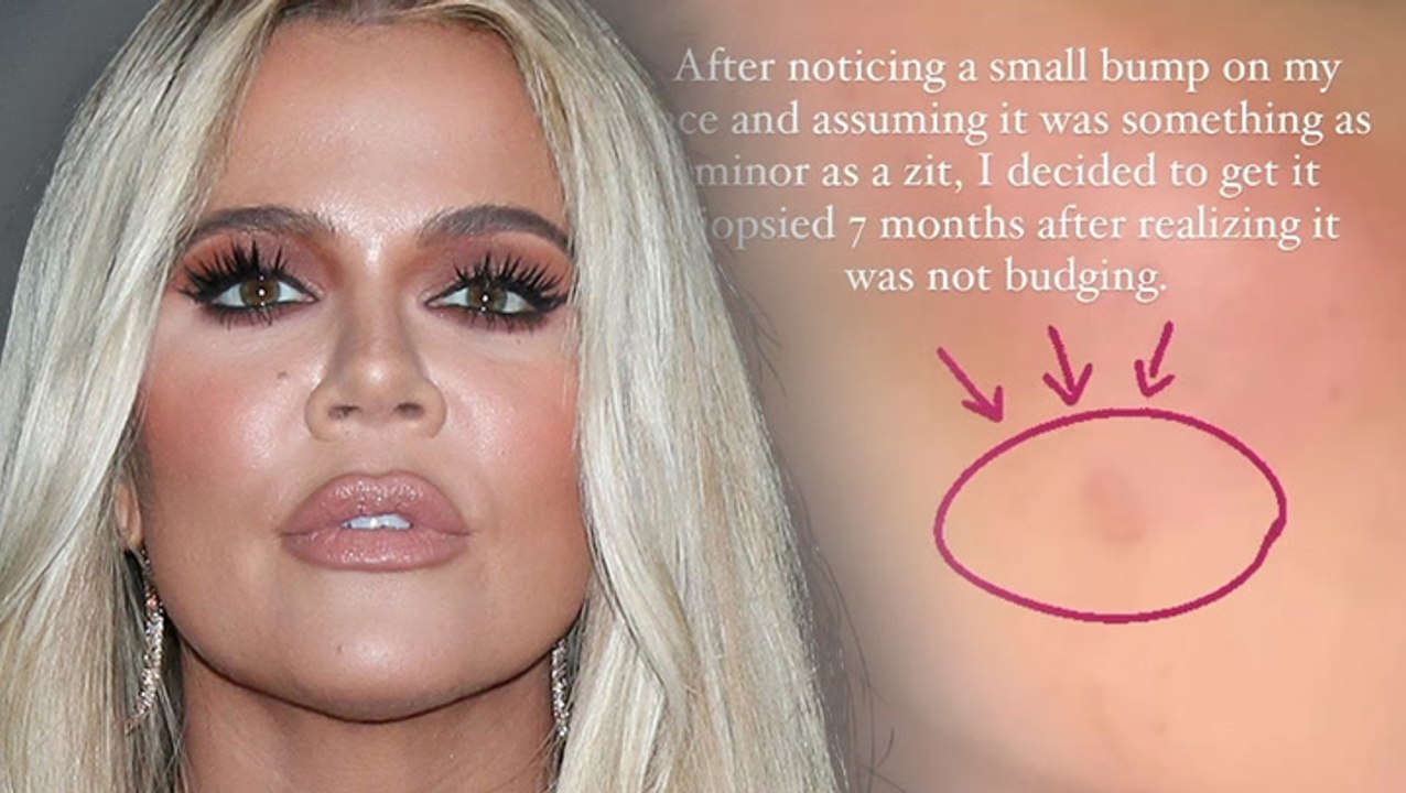 Khloe Kardashian Reveals Skin Cancer Scare After Having Tumor Removed From Her Face