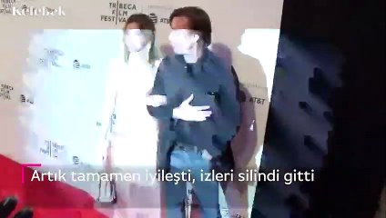 Ewan McGregor'un kızı Clara McGregor'un yüzünü köpek ısırmıştı