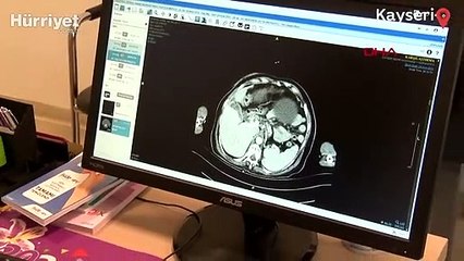 Karın şişliği şikayetiyle gitti, doktorlar da şaşırdı: Karnından 9 kiloluk tümör çıktı