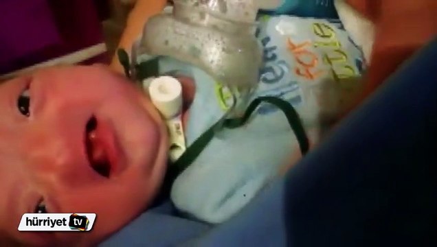 Dünya 197 milyonda bir görülen burunsuz bebeği konuşuyor