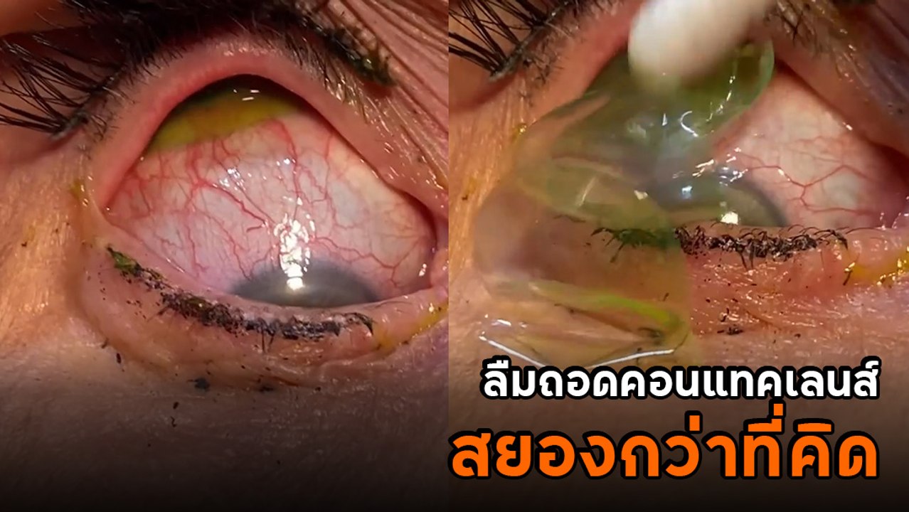 อุทาหรณ์คนขี้ลืม.. หมอถอดคอนแทคเลนส์จากตา ต่อกั...