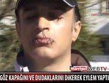 GÖZ KAPAĞINI VE DUDAKLARINI DİKTİ