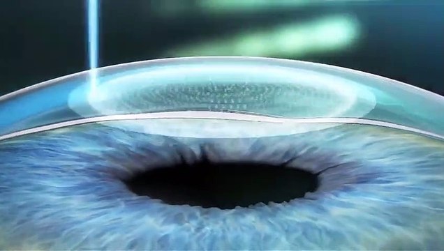 Üçüncü nesil lazer tedavisi - SMILE Lazer nedir?