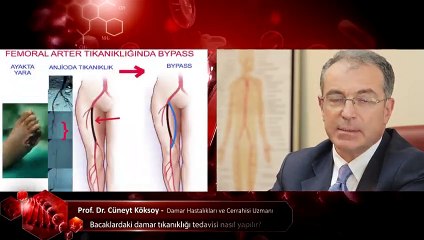 Bacaklardaki damar tıkanıklığı tedavisi nasıl yapılır?