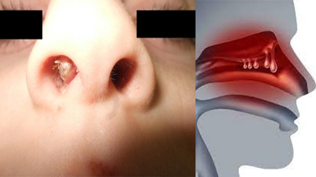 नाक में गांठ होना खतरनाक जानिए कारण और लक्षण । Naak Me Ganth Kyu Hoti । Boldsky *Health