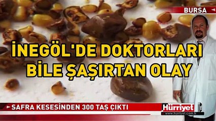 SAFRA KESESİNDEN ÇIKANLAR ŞAŞKINA ÇEVİRDİ