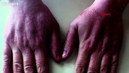 Cerrahpaşa'daki koronavirüs hastaları ilgili önemli çalışma