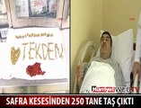 SAFRA KESESİNDEN 250 TAŞ ÇIKTI