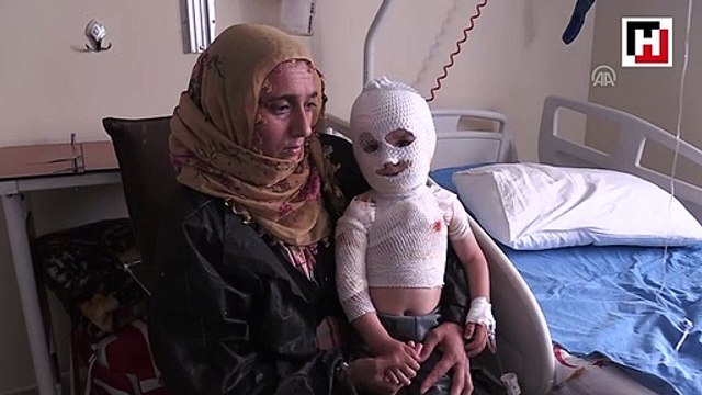 Üzerine kaynar su dökülen minik Yunus Emre iyileşeceği günü bekliyor