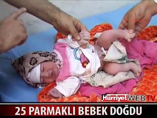 BU BEBEĞİN TAM 25 PARMAĞI VAR