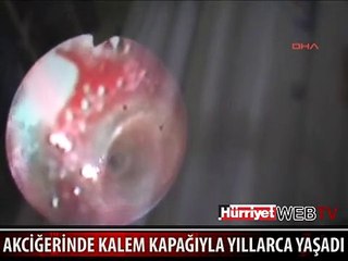 YILLARCA AKCİĞERİNDE KALEM KAPAĞIYLA YAŞADI