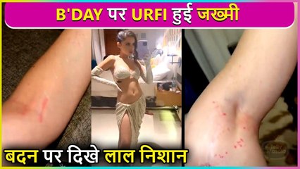 Not A Good Birthday ! Urfi Javed Gets Rashes On Her Body Due To Weird Dress