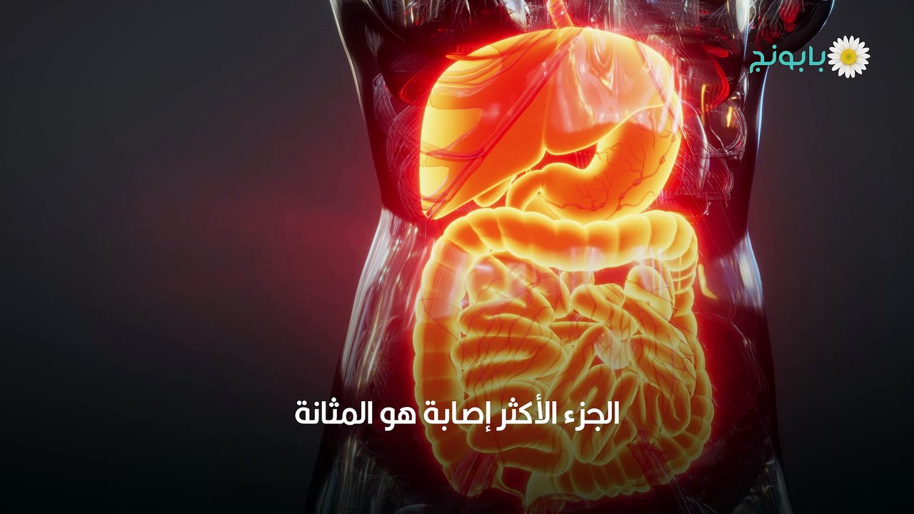 علاج التهاب المسالك البولية