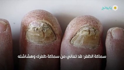 ما هي صدفية الأظافر أعراضها وعلاجها