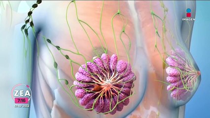 Cáncer de mama: factores de riesgo