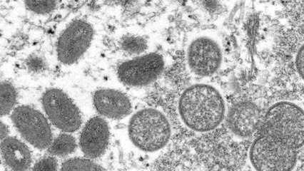 Monkeypox Reaches Taiwan