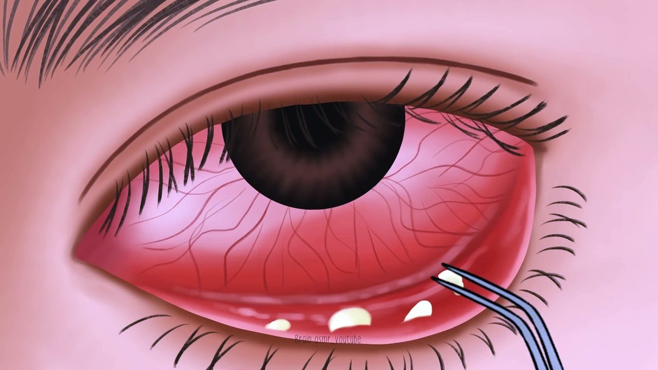 Eyelid_Sebum_Extrusion_Animation_After_Hard_Working_Day