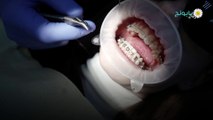 دعامات الأسنان.. ما هي وما أضرارها وفوائدها