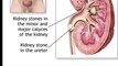 Kidney stones | kidney stones cure#dailymotion