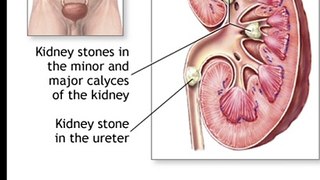 Kidney stones | kidney stones cure#dailymotion