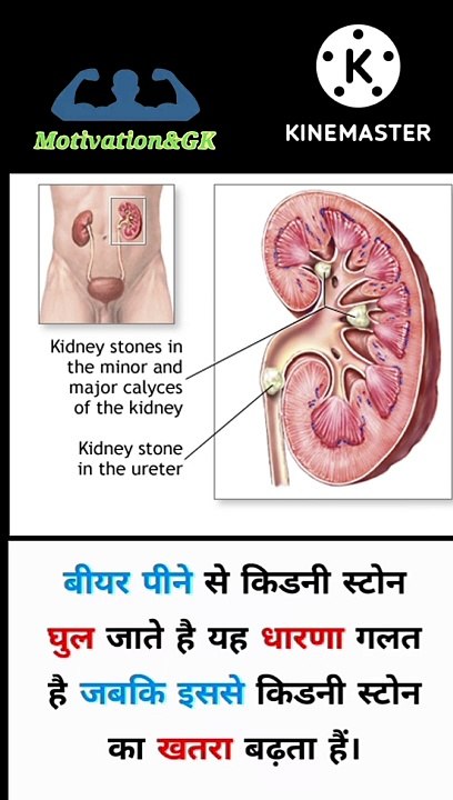 Kidney stones | kidney stones cure#dailymotion