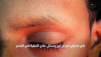 أسباب ثعلبة الحواجب وعلاجها للرجال