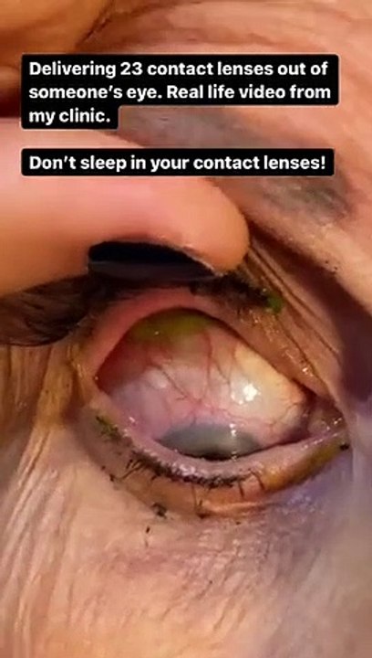 Le extrajeron 23 lentes de contacto del ojo porque se le olvido quitárselos