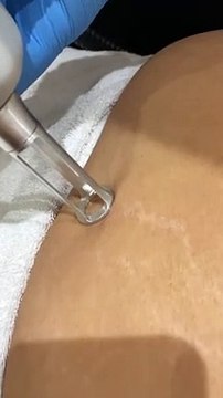 Fractional Laser Skin Resurfacing