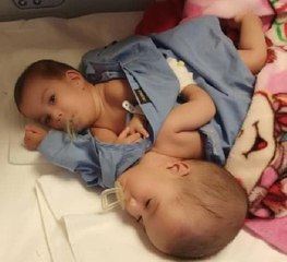 SİYAM İKİZLERİ İYİLEŞTİ TABURCU OLUYOR