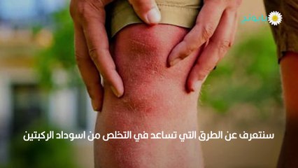 تبييض الركب والتخلص من اسودادها