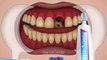 ASMR Satisfying symbios socket preservation  | Teeth cavity treatment animation