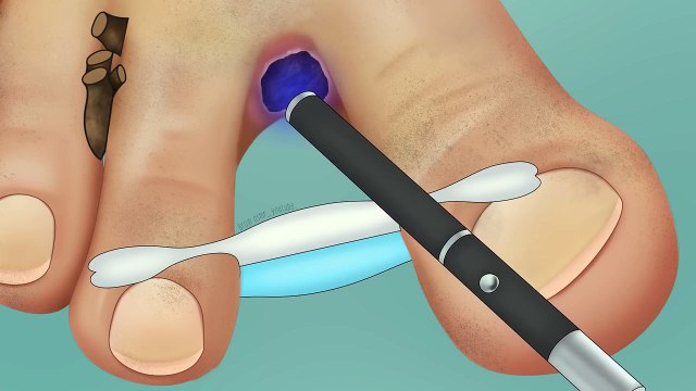 ASMR Remove fungal infection between toes | Foot care treatment animation