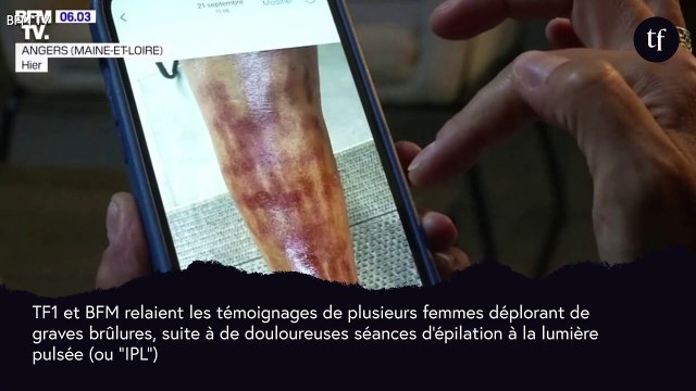 C'était insupportable : des femmes brûlées après une épilation à la lumière pulsée