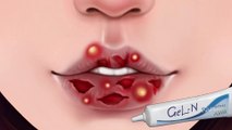 ASMR Remove Big Acne, Maggot Infection & Dry Mouth, Lip Care Animation