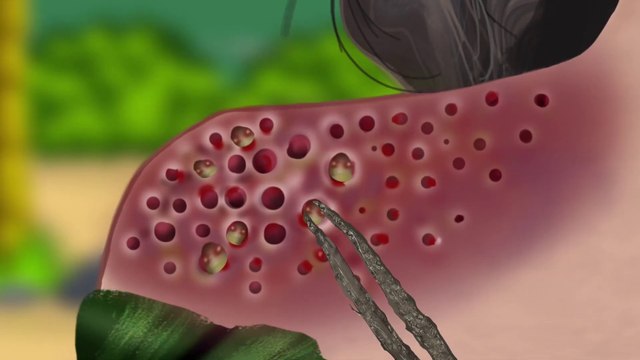 ASMR Remove Big Acne, Maggot Infection & Dry Mouth, Lip Care Animation