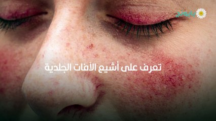 امراض جلدية