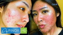 Pagkain ng mani, sanhi nga ba ng pagkakaroon ng acne breakout? | Pinoy MD