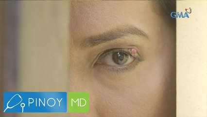 Pagkakaroon ng kuliti, ano ba talaga ang sanhi? | Pinoy MD