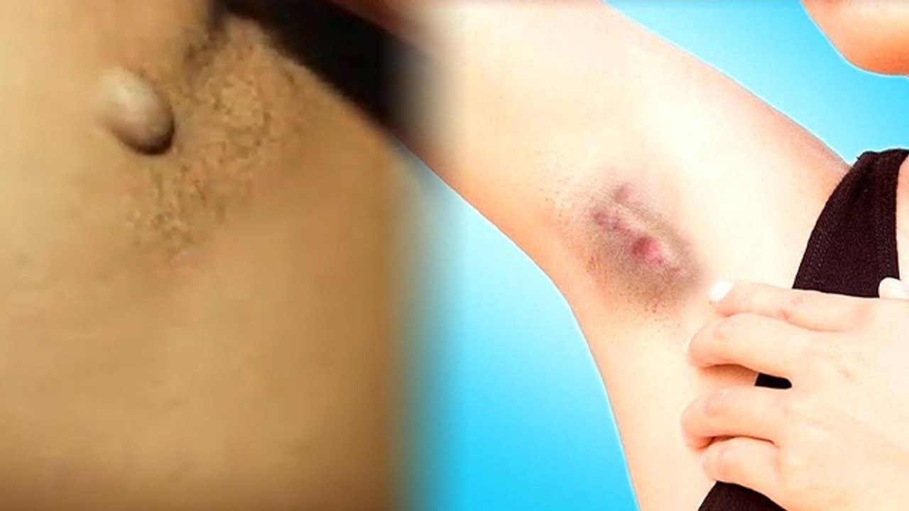 Underarms के नीचे गांठ क्यों होती है | अंडरआर्मस के नीचे गांठ होना खतरनाक जानें कारण |Boldsky*Health