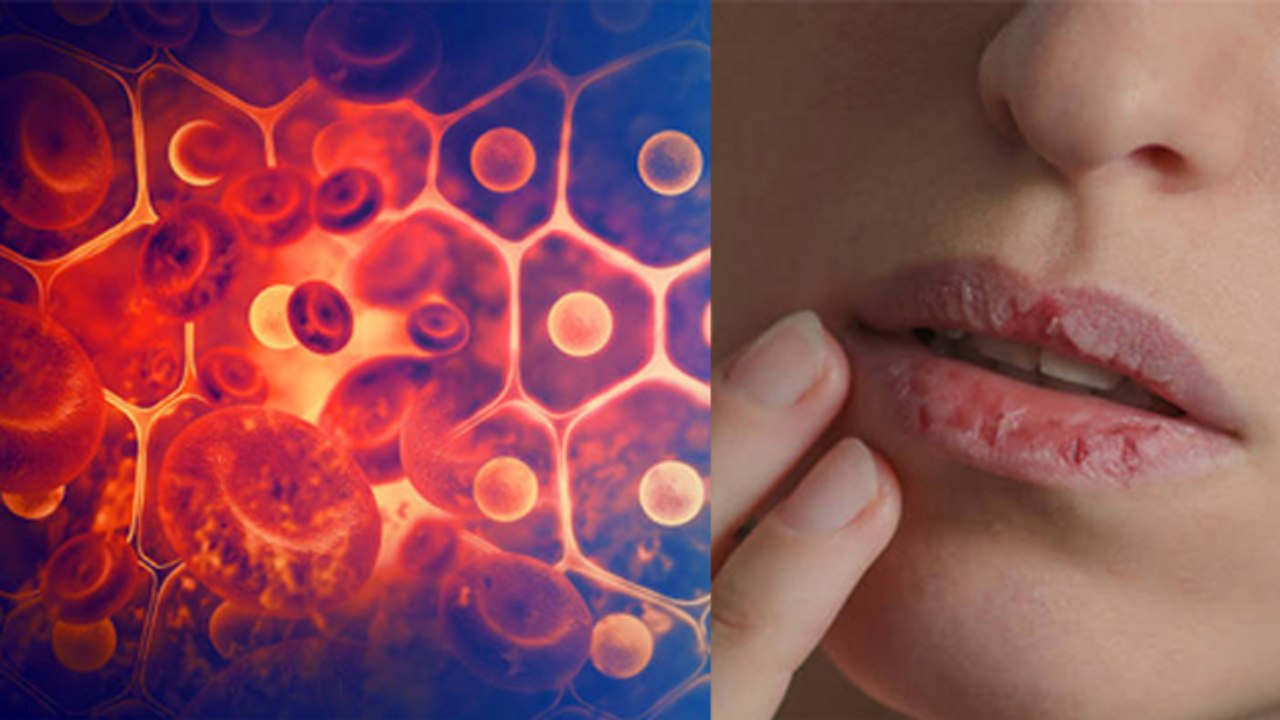 बार बार होंठ फटने का क्या कारण है, बार बार होंठ क्यों फटते है |Boldsky*Health