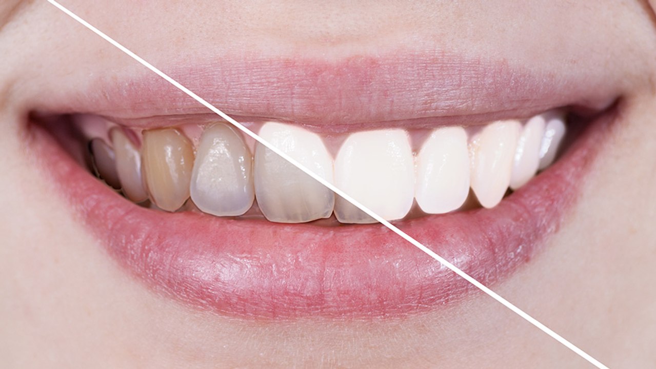 bd-causas-de-los-dientes-amarillos-011122