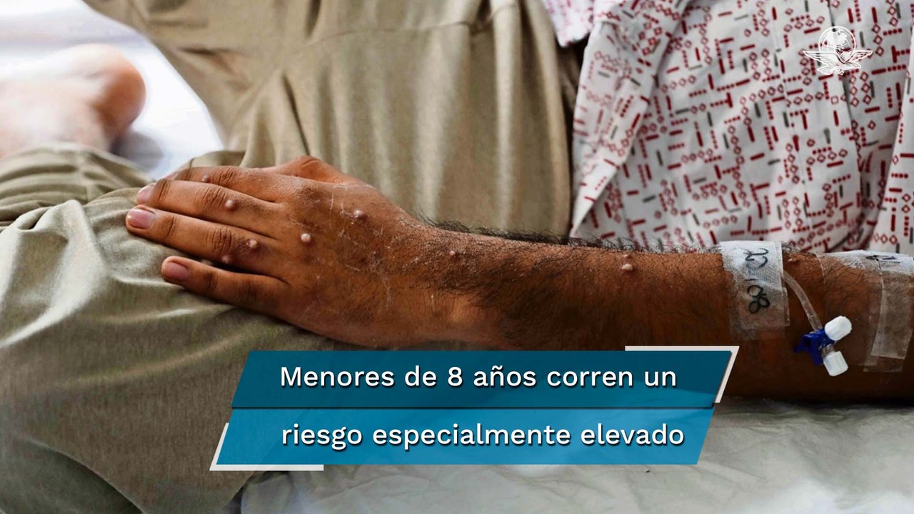 Niños menores de 8 años deberían ser vacunados si se extiende el brote de viruela del mono