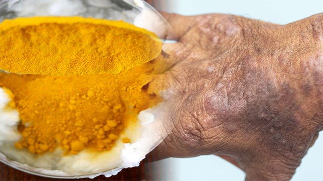 शरीर से काले दाग मिनटों में करें दूर बस अपनाएं ये घरेलू उपाय । Boldsky *Health