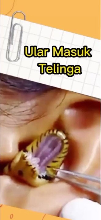 Ular Masuk Telinga