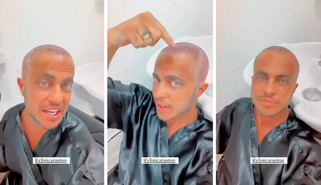 ‘Achei que ia ficar feio careca’, diz Thammy Miranda sobre transplante capilar