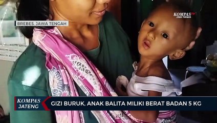 Gizi Buruk, Anak Balita di Brebes Miliki Berat Badan 5 Kg