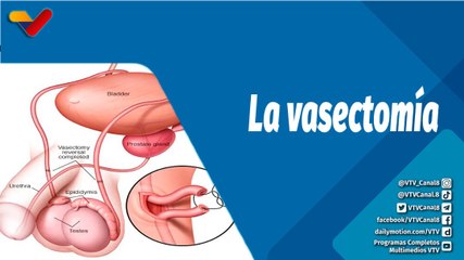 Actitud Saludable | Conoce los beneficios para los hombres al realizarse la vasectomía