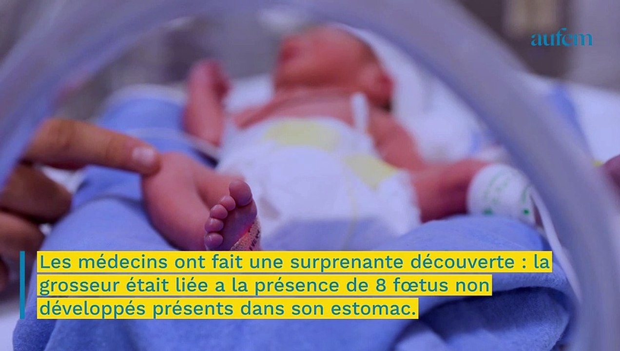 Un bébé naît avec huit foetus non développés dans son estomac Vidéo