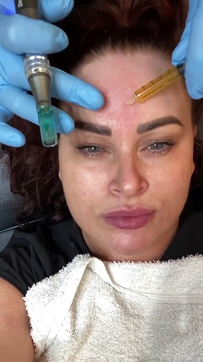 PRF Platelet Rich Fibrin Microneedling - Fiore Aesthetics